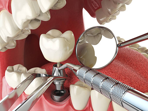 Best Emergency Root Canal Treatment in Delisle, MS