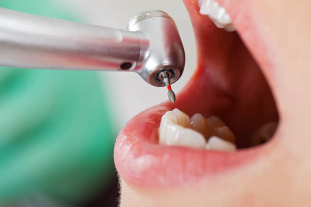 Best Emergency Root Canal Treatment in Delisle, MS